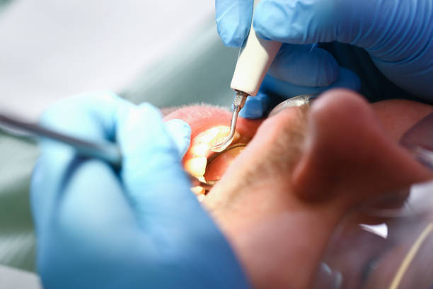 Best Emergency Dentist for Knocked-Out Tooth in Estes Park, CO